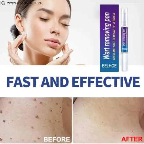 Wart Removing Pen
